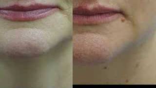 Erbium Laser Resurfacing Before and After Phots [upl. by Cormier]