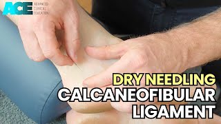 Dry Needling Calcaneofibular Ligament CFL [upl. by Aikemot302]