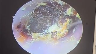 Hard cerumen embolism and dry slice cleaning earwax Cleaning earwaxremoval satisfying [upl. by Llenrahs242]