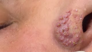 Suri Job 675 Awesome Blackheads Extraction [upl. by Harlen323]