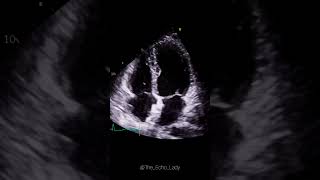 Closure device in situ 🩵🫀 cardiology amplatzer cardiologia echocardiogram [upl. by Siddra]