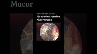 NEJM Images in Clinical Medicine Rhinoorbitalcerebral Mucormycosis [upl. by Rafael101]