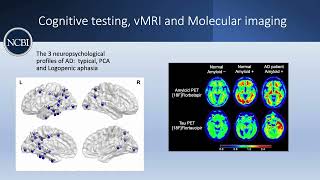 Can Alzheimer’s Disease Be Diagnosed in Living Patients [upl. by Anileda556]