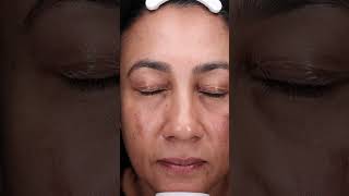 A demonstration of the mesoestetic® mesopeel® melanostop tran3x with Luxe Skin Aesthetics UnboxMe [upl. by Enerahs]