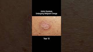 Skin Cancer Development Time Lapse Normal to Squamous Cell Carcinoma Over 25 Years [upl. by Carboni]