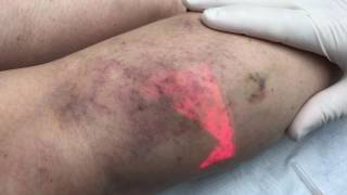 Angiogenesis Complication After Sclerotherapy [upl. by Mighell]