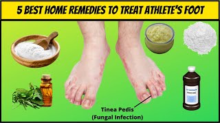 5 Best Natural Home Remedies For Athletes Foot  How To Get Rid of Athletes Foot Home Remedies [upl. by Ahsenet179]