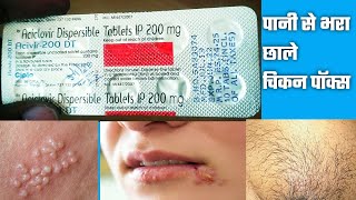 Acivir 200 DT Tablet  Aciclovir 200mg Tablet  Acivir 200mg DT Tablet मुंह के ऊपर छाले बदन पे छाले [upl. by Eerat966]