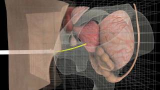 Interactive Simulation of Surgical Needle Insertion and Steering [upl. by Daniell]