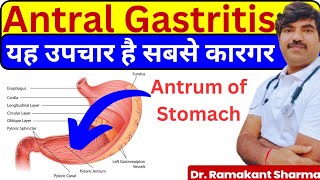 Antral Gastritis Causes Symptoms and Effective Treatments drramakantsharma7 [upl. by Bolling]