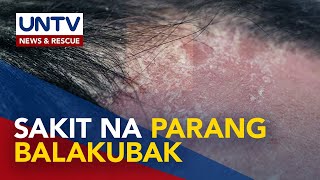 ALAMIN Makati masakit at makapal na balat na tila dandruff sintomas ng seryosong sakit [upl. by Airotahs]