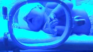 Jaundice treatment  Blue Light Special [upl. by Itoyj]