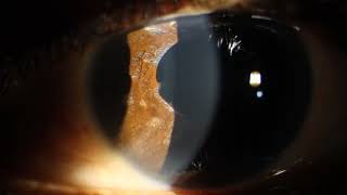 Traumatic Glaucoma with Iris Synechiae amp Pigment Dispersion [upl. by Cohdwell]