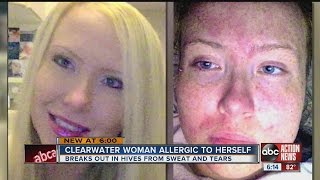 Julie Reid 28 suffers from Cholinergic Urticaria a hypersensitive skin condition causing hives [upl. by Eltsryk732]