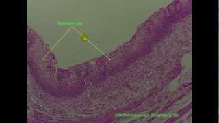 Stratified Epithelial 2 of 2 [upl. by Notsur]