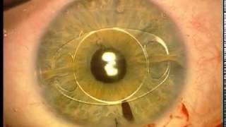 Ectopic Lens Extraction Artisan IOL Implantation Vladimir Pfeifer [upl. by Odnalro890]