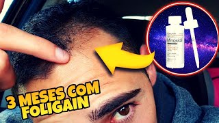 3 meses testando o Minoxidil Foligain É tão bom quanto o Kirkland Minha opinião sincera [upl. by Reggie]