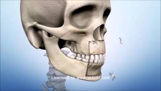 ASO Anterior Segmental Osteotomy Bimaxillary protrusion bird face 돌출입 [upl. by Rorie]