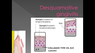 Dental lecture topic Desquamative Gingivitis [upl. by Friedberg]