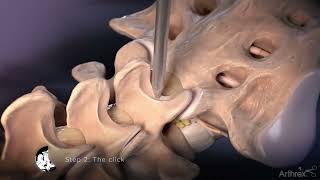 Interlaminar Approach for Discectomy Procedures [upl. by O'Connor]