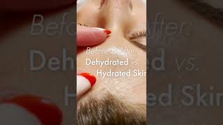 Before amp After Dehydrated vs Hydrated Skin [upl. by Sydalg]