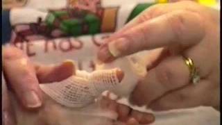 ABCs Hand Wrapping Technique Epidermolysis Bullosa [upl. by Airliah771]