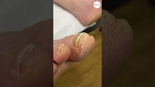 Tip of Big Toe Callus [upl. by Arised567]