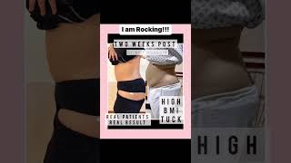 High BMI Tummy Tuck Journey Precision Liposuction amp Sculpting plasticsurgery beforeandafter [upl. by Sarnoff]