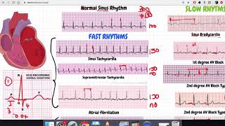 Arrhythmias Made Simple  Quiz Part 2 [upl. by Hill30]