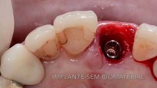 CIRURGIA GUIADA PARCIAL ANTERIOR COM PROVISÓRIO [upl. by Dnalyaw]