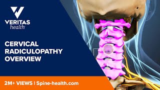 Cervical Radiculopathy Overview [upl. by Nomra977]