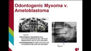 Odontogenic myxoma [upl. by Erot]