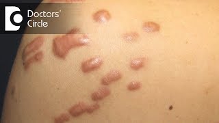 Can Keloids be removed by laser treatment  Dr Rajdeep Mysore [upl. by Drexler]