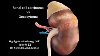 Renal Cell Carcinoma vs Oncocytoma Highlights in Radiology Episode 13 [upl. by Jacobine]