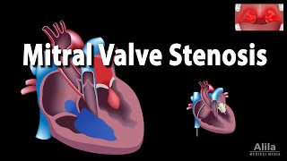 Mitral Valve Stenosis Animation [upl. by Ennaylime]