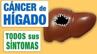 Todos los Síntomas del Cáncer de Hígado [upl. by Lilyan]