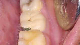 HOW TO MIX DENTAL CEMENTS AND PREVENT CHIPPING OF PFM CROWNS [upl. by Enorej]