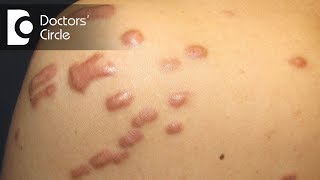 What is the best treatment for Keloid in young people  Dr Pavan Murdeshwar [upl. by Adnerb]