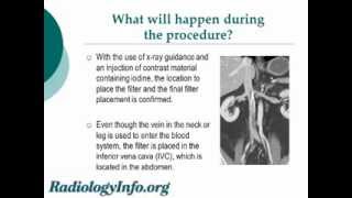 Your Radiologist Explains Inferior Vena Cava IVC Filter Placement and Removal [upl. by Einrae]