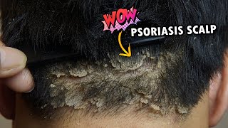 Wow Psoriasis Dry Scalp Scratching So Much Dandruff Removal Satisfying 363 [upl. by See]