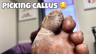 ODDLY SATISFYING CALLUS DEBRIDEMENT [upl. by Notserk]