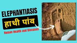 Elephantiasis Symptoms  Filariasis Class 12  Human Health and Diseases [upl. by Seton600]