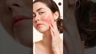 Removing pimples on face chahre se dane or dagh hatane keliye [upl. by Eillit150]