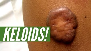 What are KELOIDS And how can you get rid of them [upl. by Aelak]