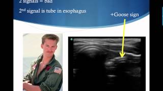 Confirming Endotracheal Tube Placement with Ultrasound [upl. by Madaras]