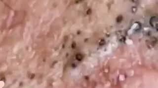 Relax With BlackHead Removal  Get Ready for an Intense Pimple Popping Adventure Video [upl. by Anikal101]