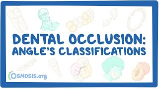 Dental occlusion  Angle’s classifications [upl. by Felicidad]