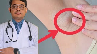 লিম্ফ নোড ফুলে যাওয়াReactive Lymph node swelling [upl. by Haelat306]