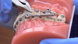 American Orthodontics PowerScope Activation [upl. by Adina]