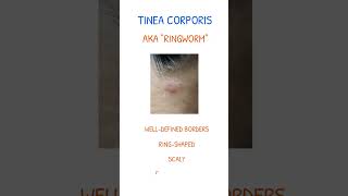 TINEA CORPORIS SYMPTOMS amp TREATMENT [upl. by Enymsaj]